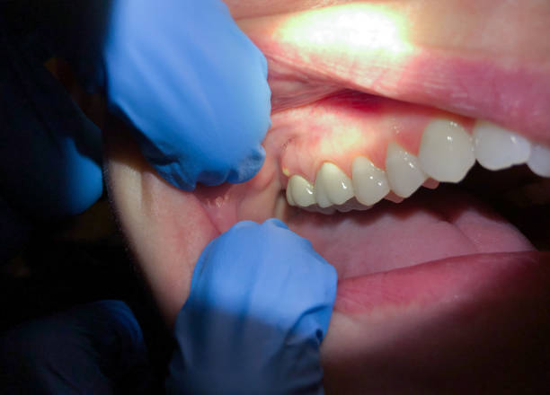 Best Tooth Infection Emergency Dentist  in Summerset, SD